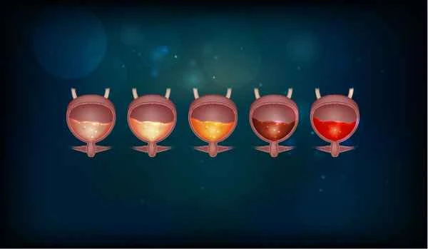 How to relieve urinary difficulties in colon cancer?