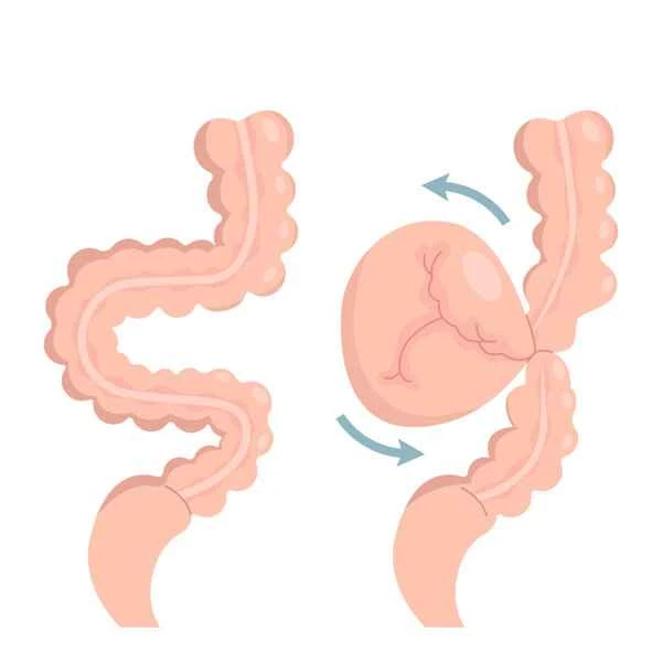 What to do if bowel obstruction occurs after colonoscopy?