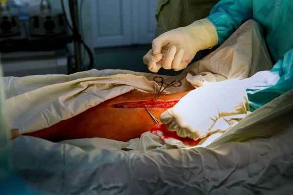 Does a one-centimeter intestinal polyp require surgery?