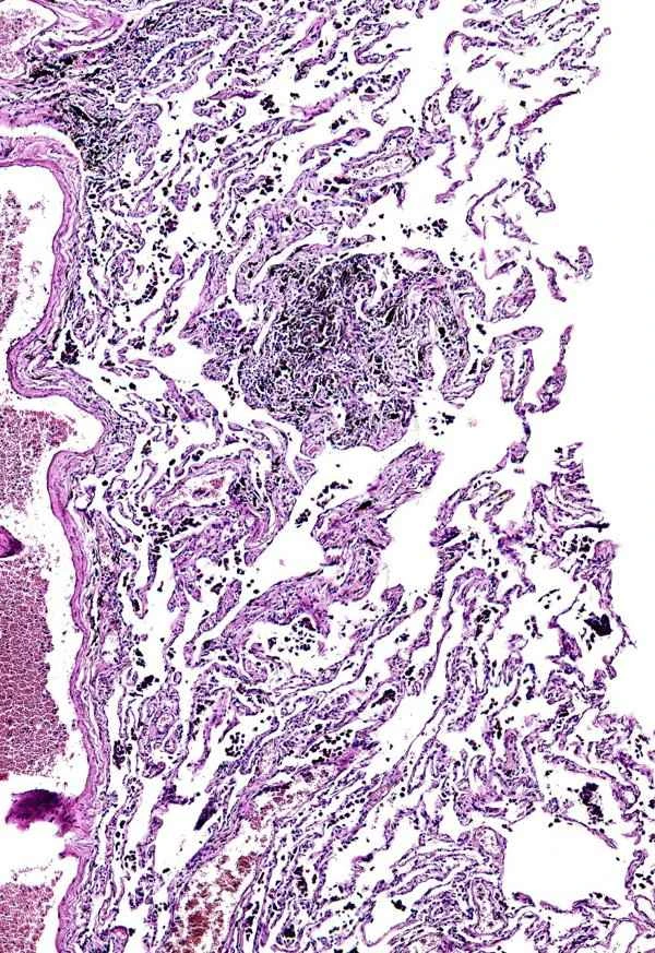 Can inflammatory gastric polyps turn into cancer?
