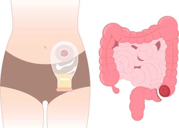 At what size can intestinal polyps be surgically removed?