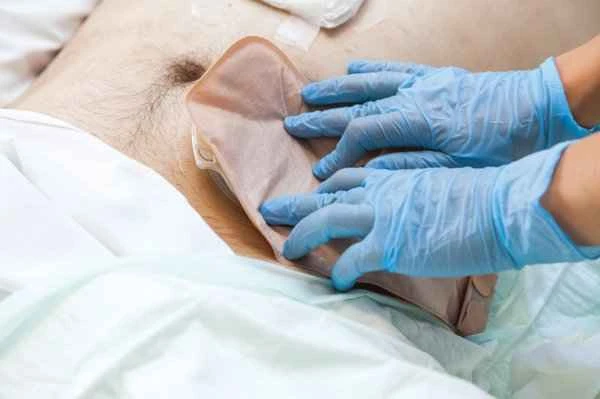 Is it normal to experience anal pain when having colorectal polyps removed?