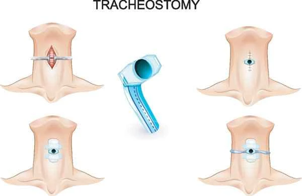 What type of obstruction is colonic obstruction?