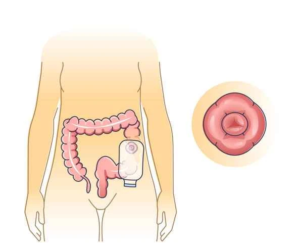 Can I eat lamb, beef, or chicken if I have intestinal polyps?