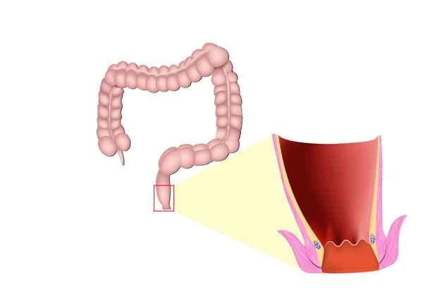 Is small bowel obstruction easy to treat?