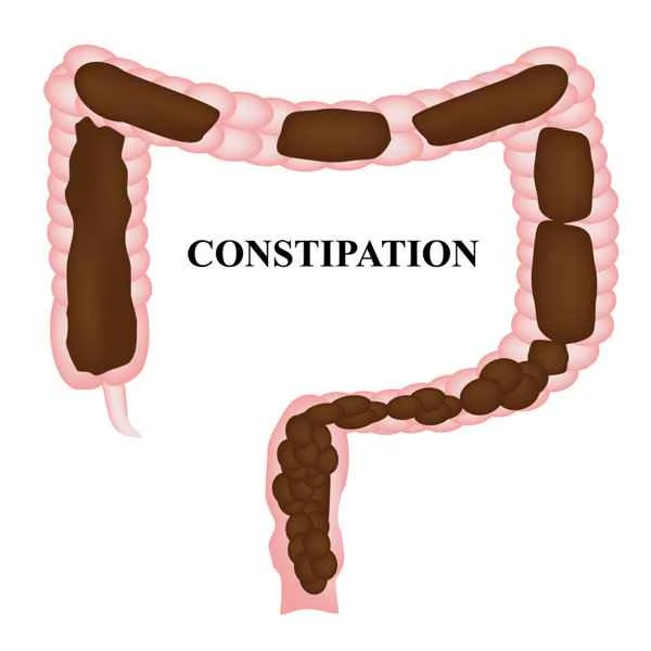 How to treat constipation and intestinal polyps