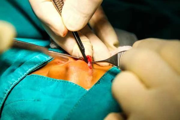 Can I eat beef after having intestinal polyps removed?