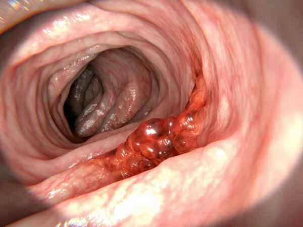 Can duodenal fistula be repaired?