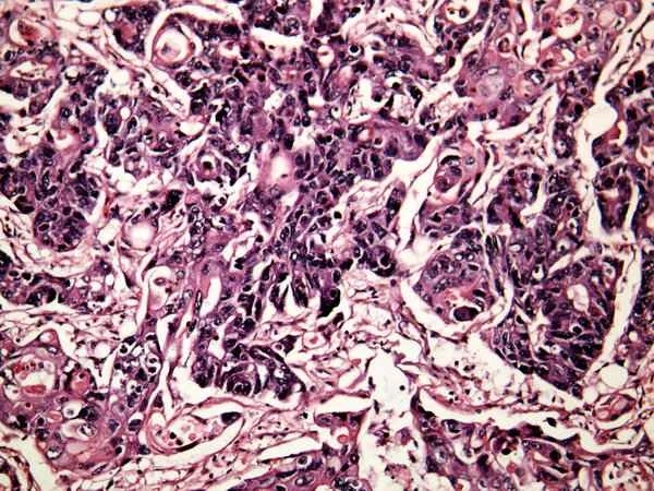 Is it serious to have a tubular adenoma in the colon?