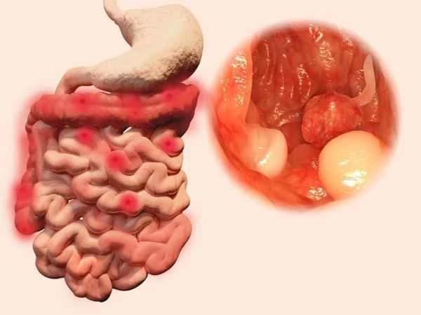 Why do children get intestinal polyps?