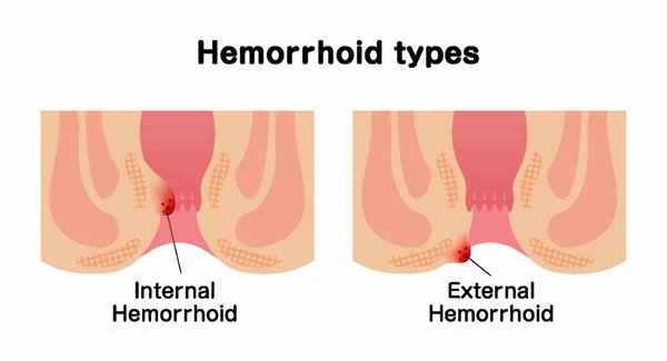 Why does intestinal polyp cause anal discharge?