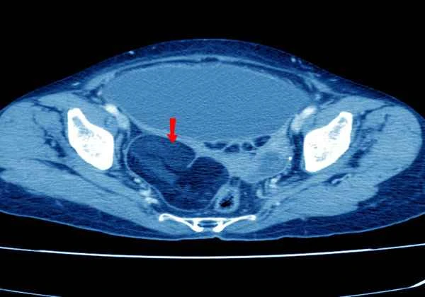 What department treats abdominal adhesions?