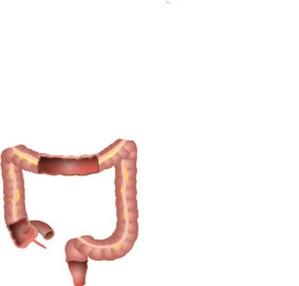 Postoperative care after radical resection of sigmoid colon cancer