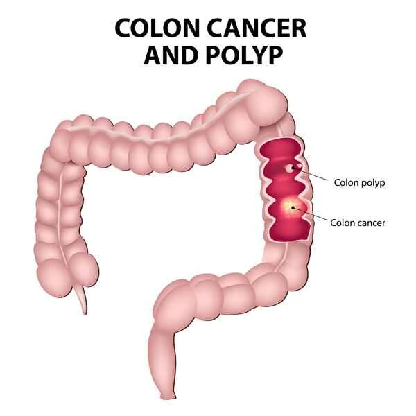Does colon cancer cause difficulty urinating?