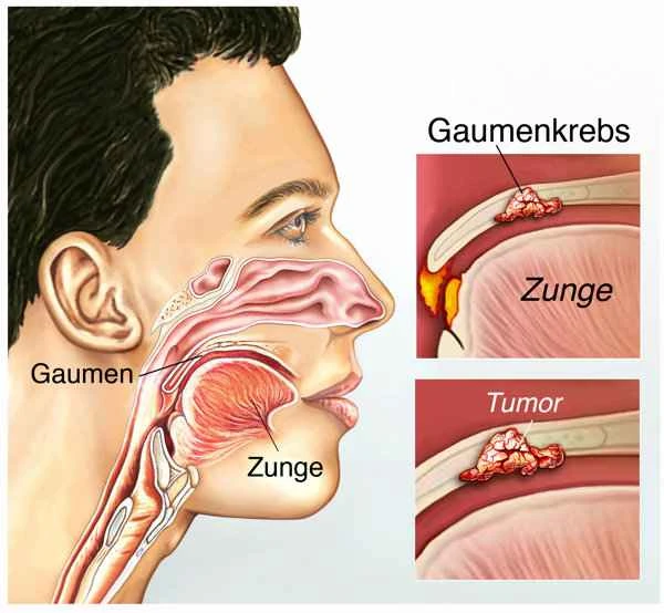 Is appendiceal mucinous tumor cancer?