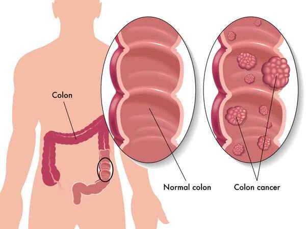 Does colon cancer cause difficulty urinating?