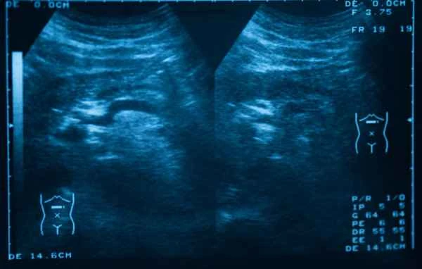 How much does a color Doppler ultrasound cost for intestinal obstruction in young children?