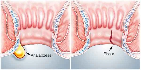 Why does intestinal obstruction keep recurring?