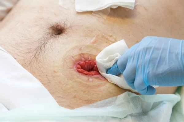 What to do if you get an infection after appendectomy?