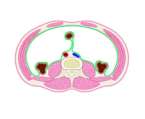 Will intestinal perforation last a lifetime?