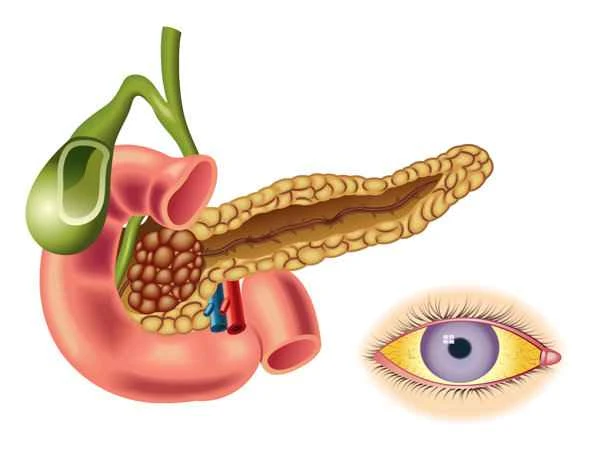 Does chronic pancreatitis cause intestinal obstruction?