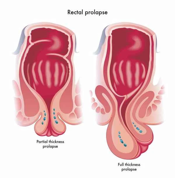 Will intestinal polyps cause anal discomfort?