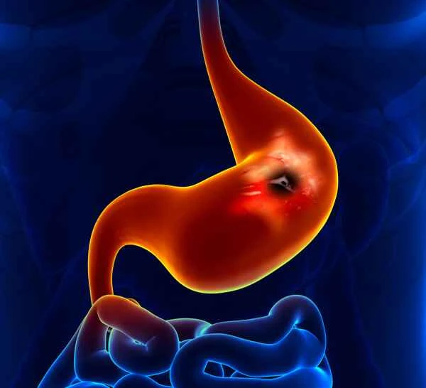 Is intestinal polyp-induced erosive gastritis serious?