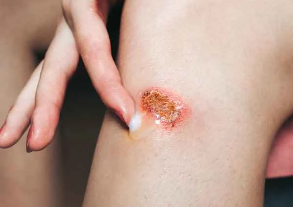 Does appendicitis with suppuration always require surgery?