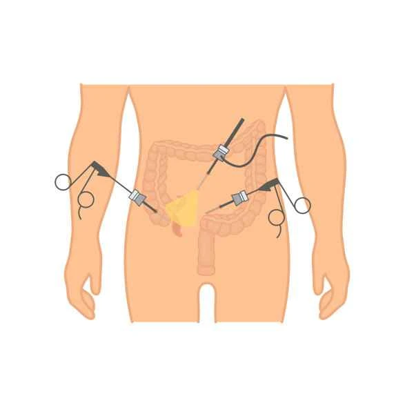 Is appendiceal mucinous tumor cancer?