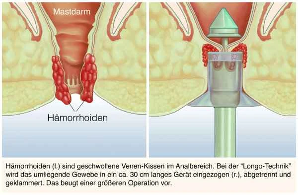 How long does it take to cure intestinal polyps?