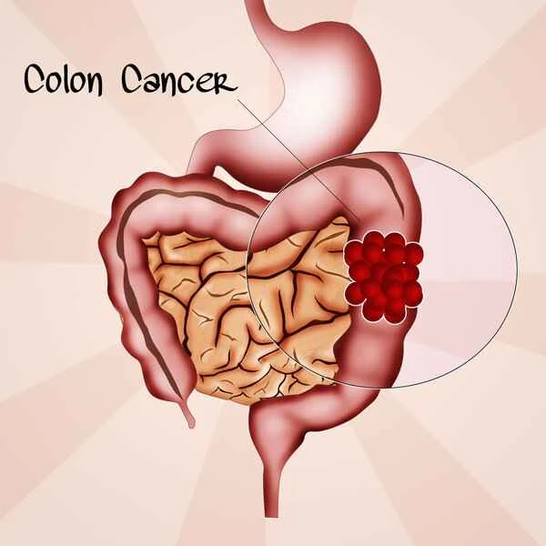 What is a villous adenoma of the intestine?