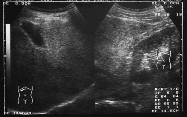 What are the symptoms of bowel obstruction?